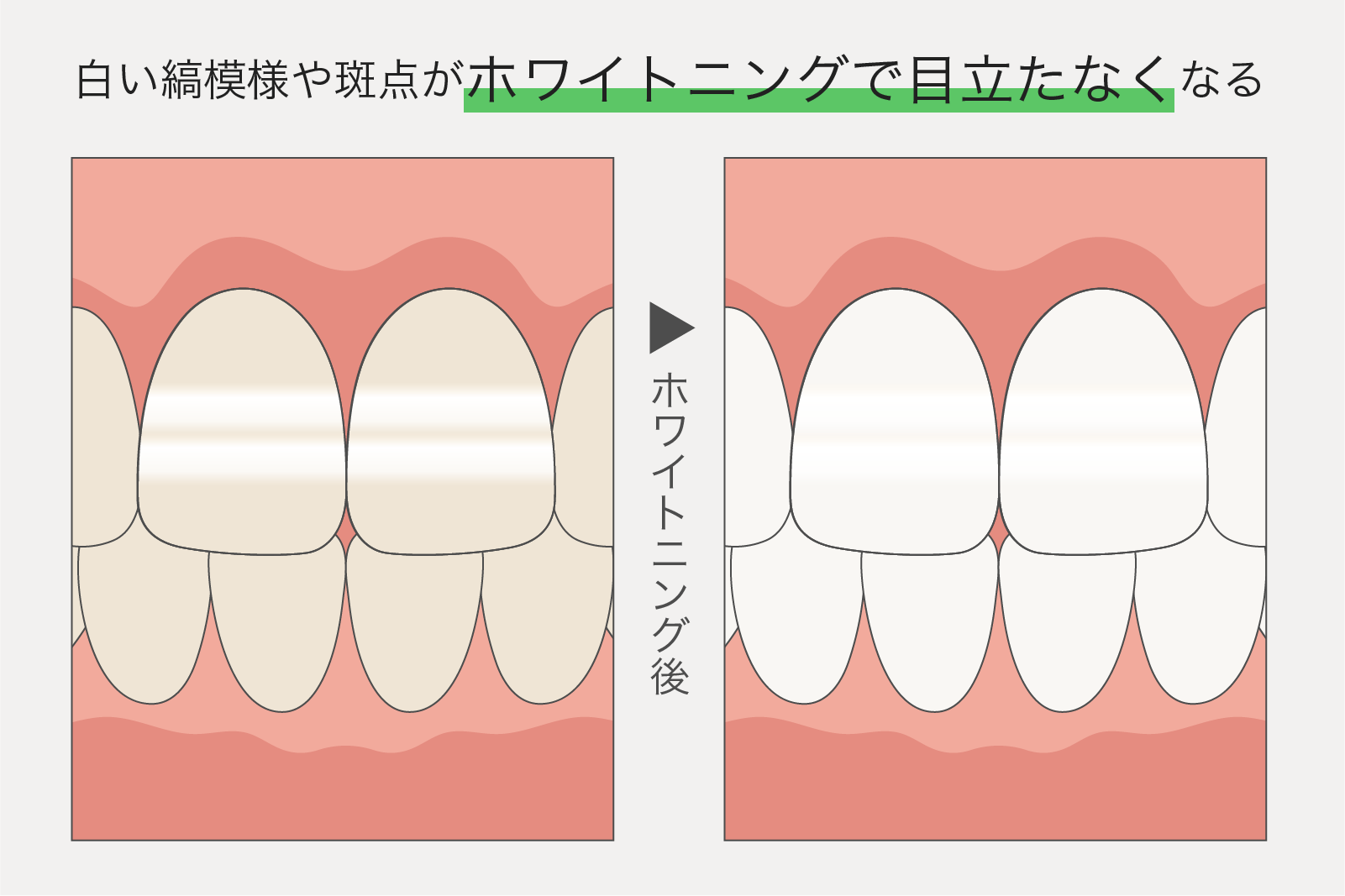 ホワイトニングの注意点